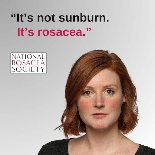 rosacea awareness