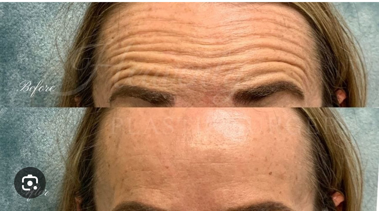 Before and After Image: Neurotoxin - front
