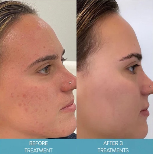 Before and After Image: Microneedling with SkinPen - right-side