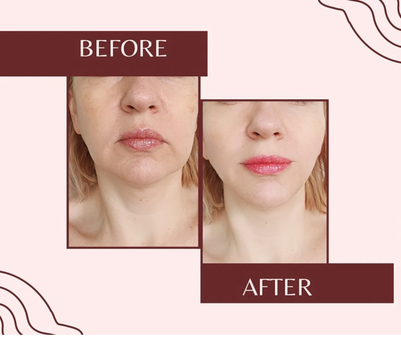 Before and After Image: Botox Lip and Chin - front