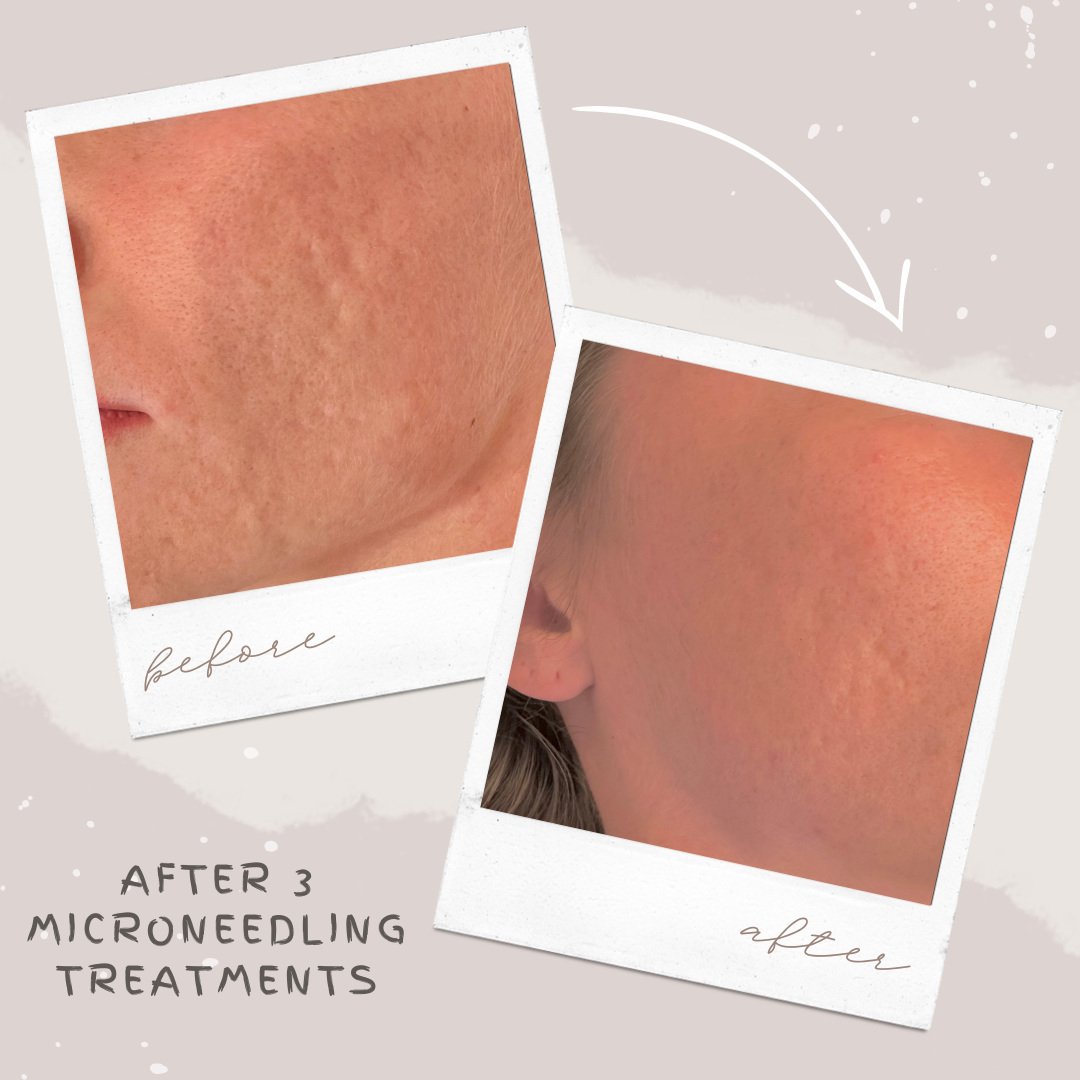 Before and After Image: Microneedling - left-front-oblique