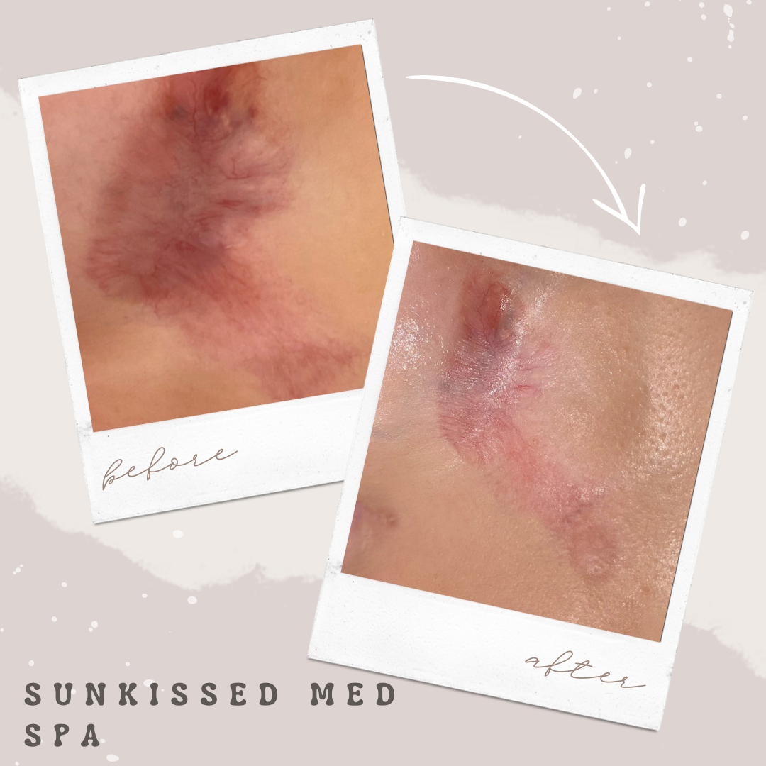 Before and After Image: Microneedling - front