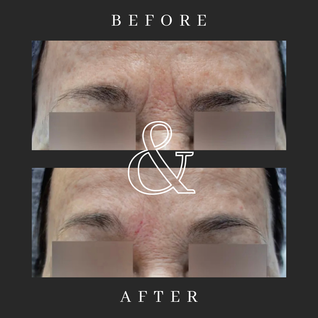 Before and After Image: Treatment of Glabella complex with Jeuveau - front