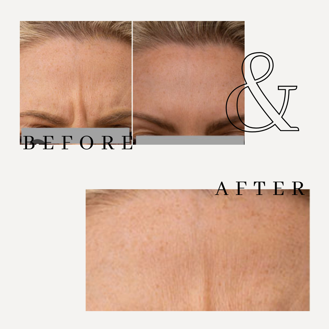 Before and After Image: Treatment of Glabella complex with Jeuveau - front
