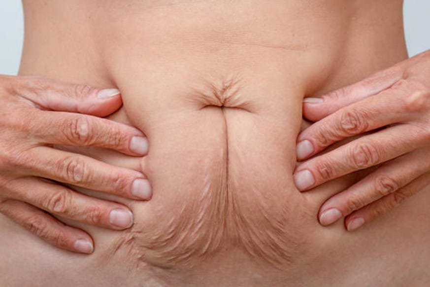 Understanding Skin Laxity Causes, Treatments, and the Role of T Shape 2 1