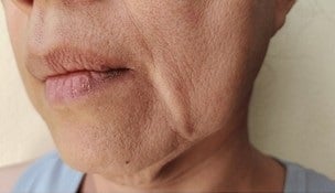 Understanding Skin Laxity Causes, Treatments, and the Role of T Shape 2 2