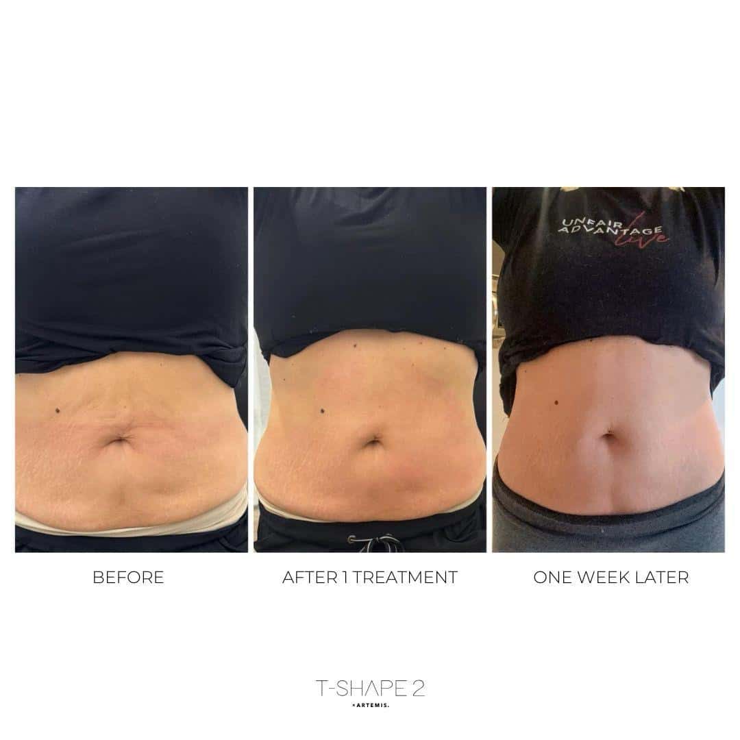 Before and After Image: T-Shape 2 - front