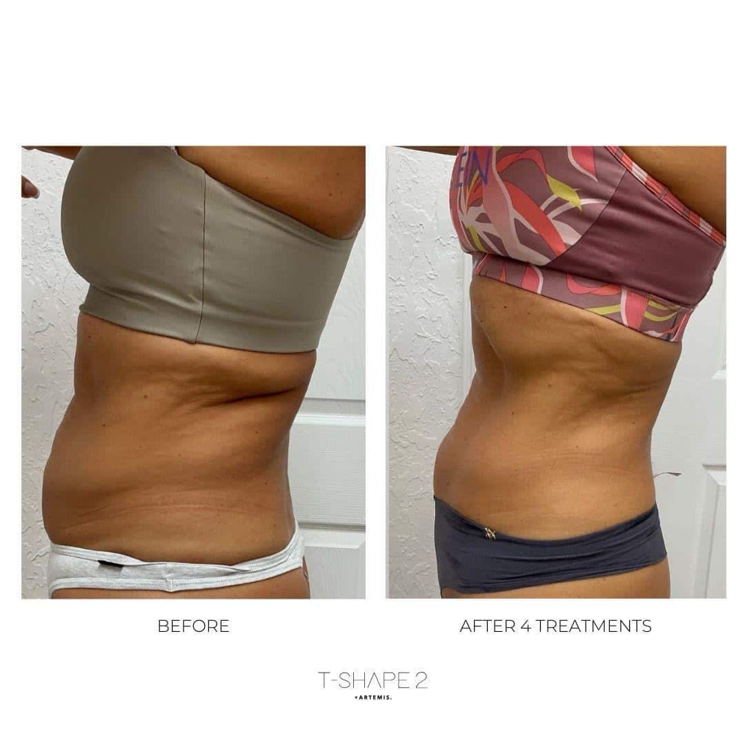 Before and After Image: T-Shape 2 - left-side