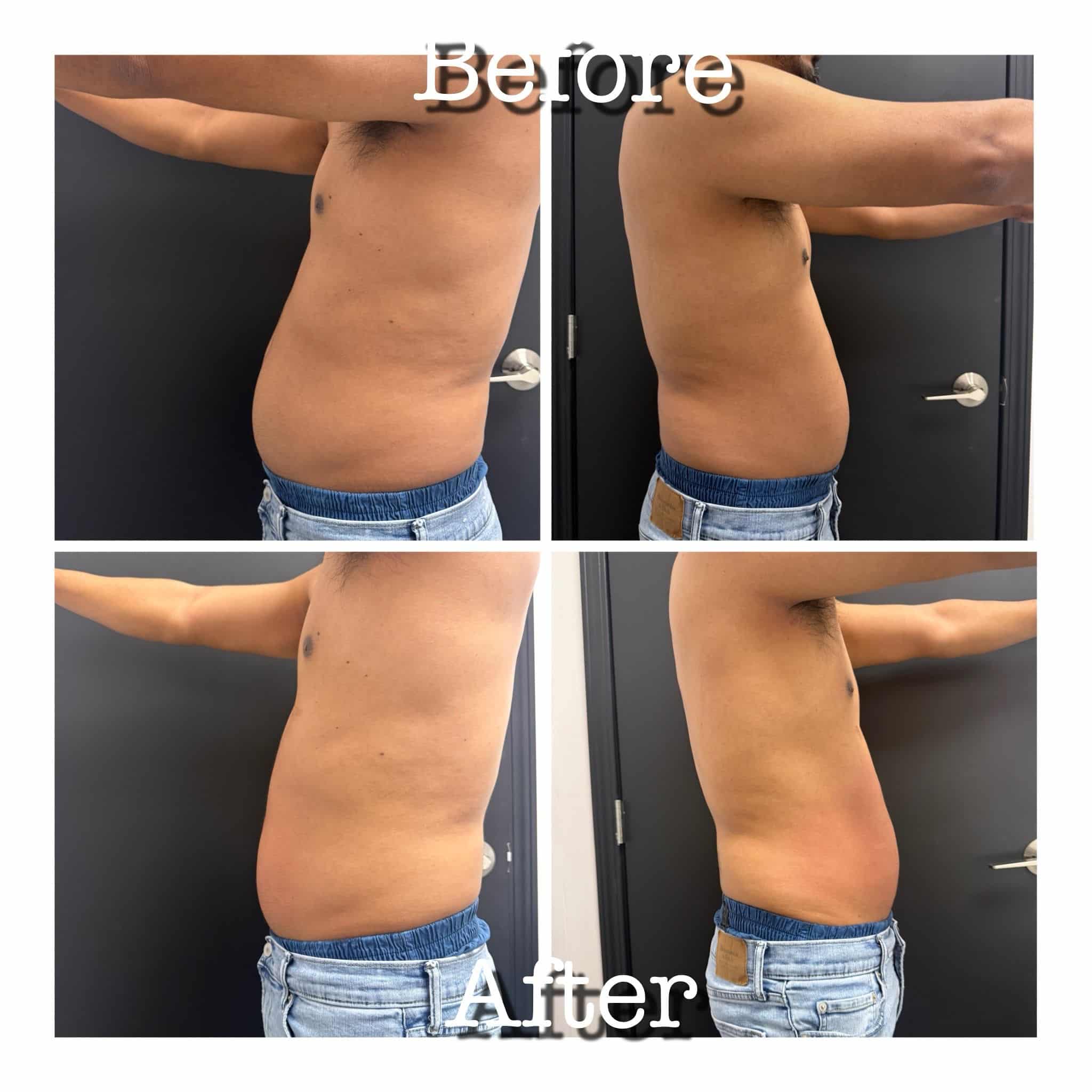 Before and After Image: T-Shape 2 - front