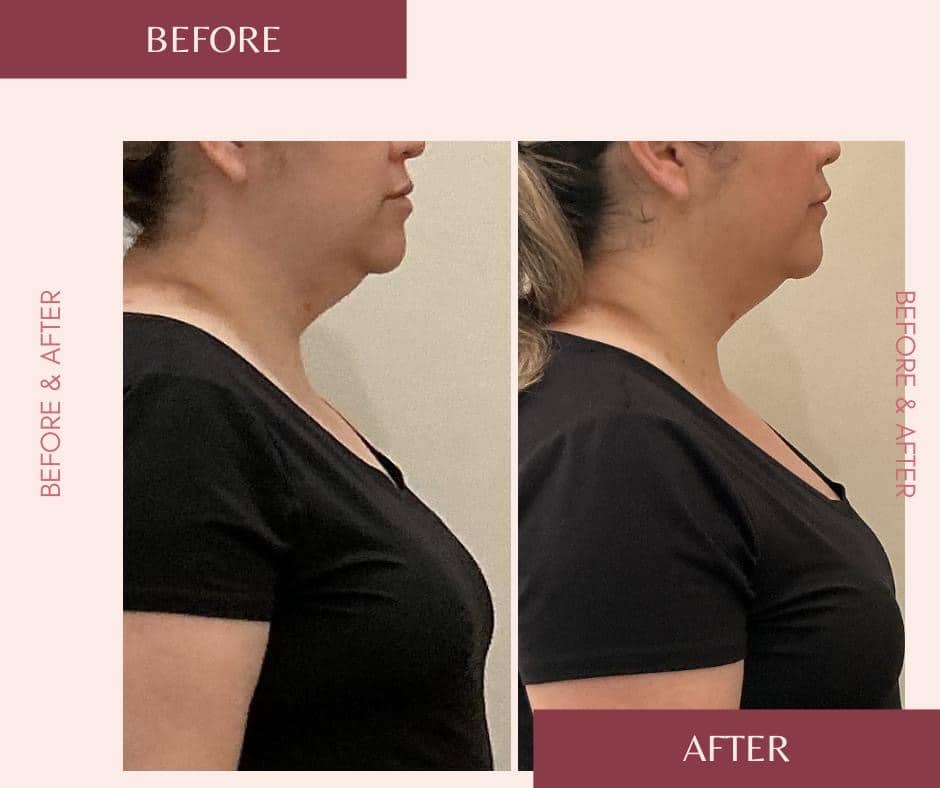 Before and After Image: T-Shape 2 - right-side