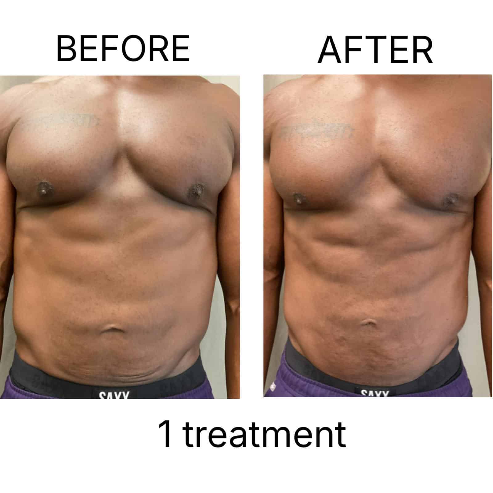 Before and After Image: T-Shape 2 - front