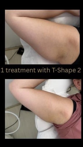 Before and After Image: T-Shape 2 - front