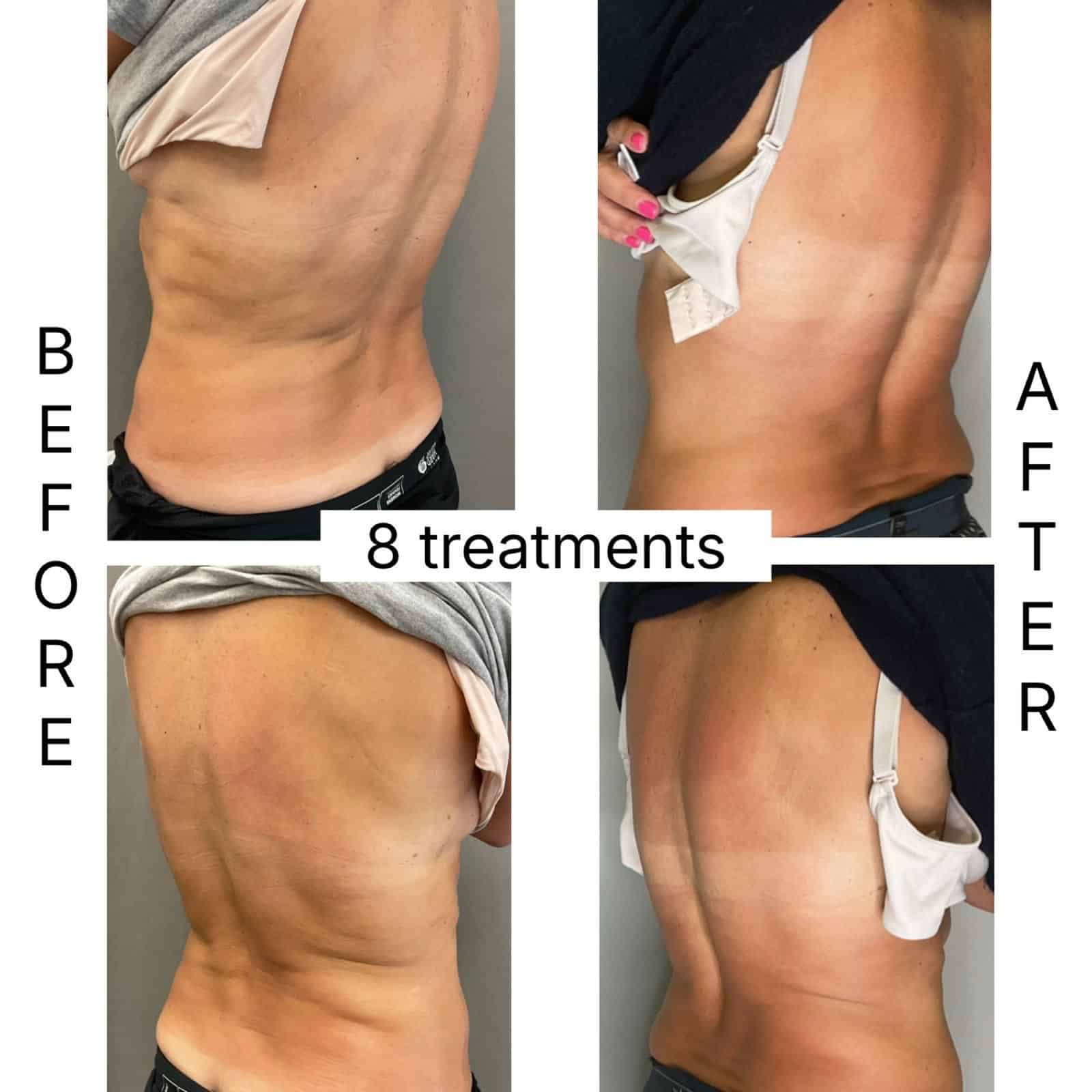 Before and After Image: T-Shape 2 - back