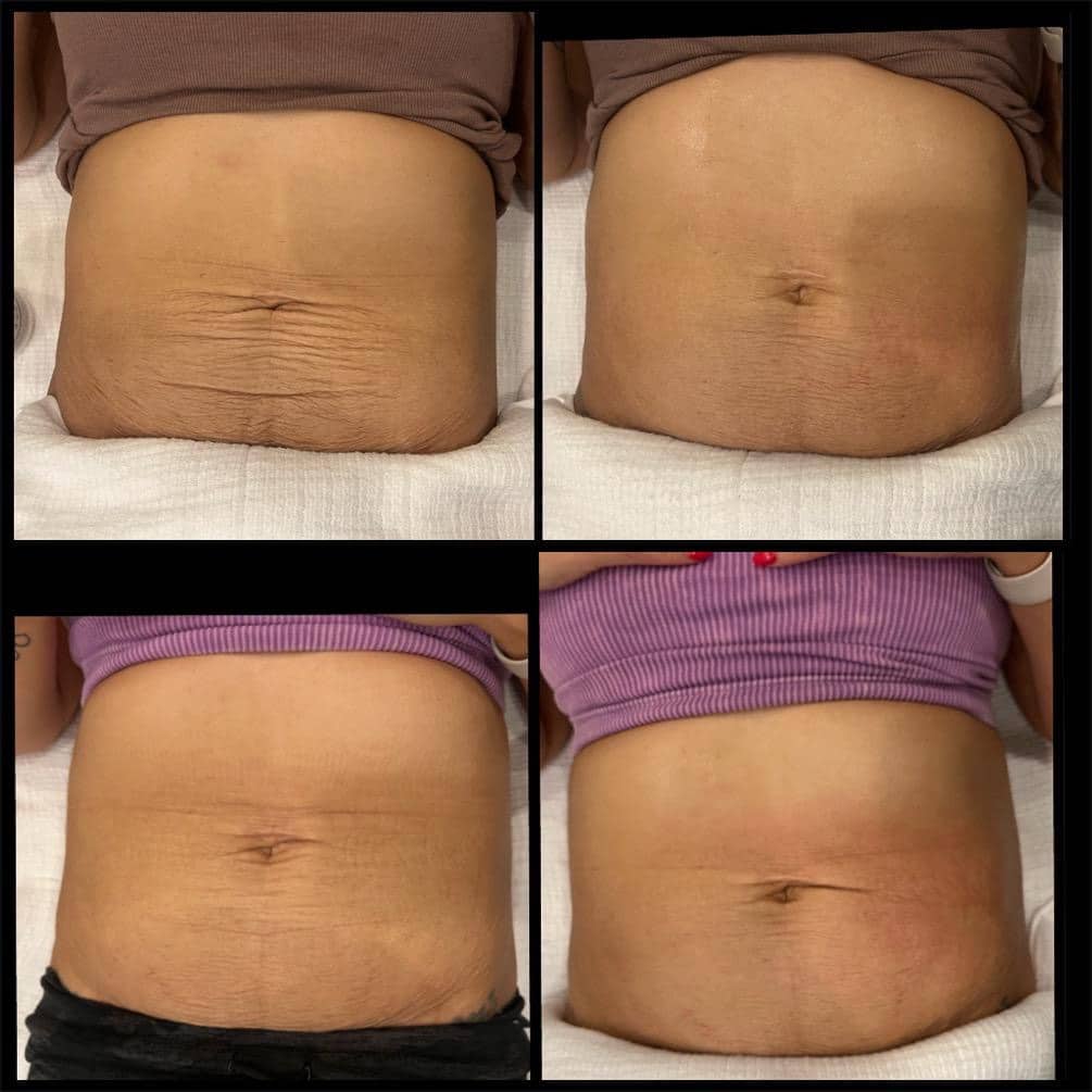 Before and After Image: T-Shape 2 - front