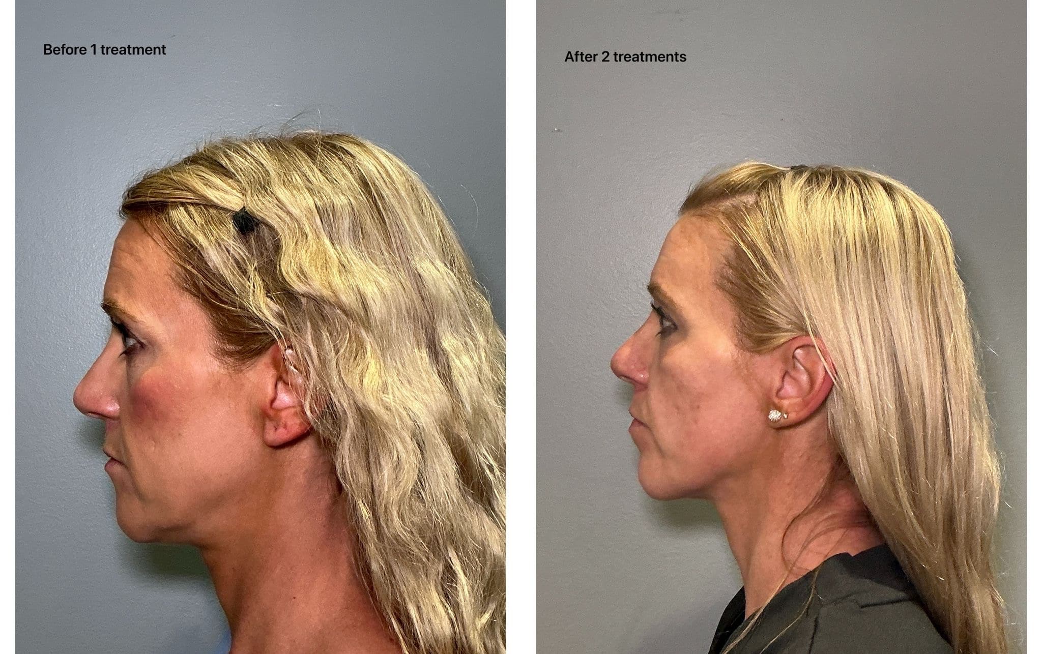 Before and After Image: T-Shape 2 - left-side