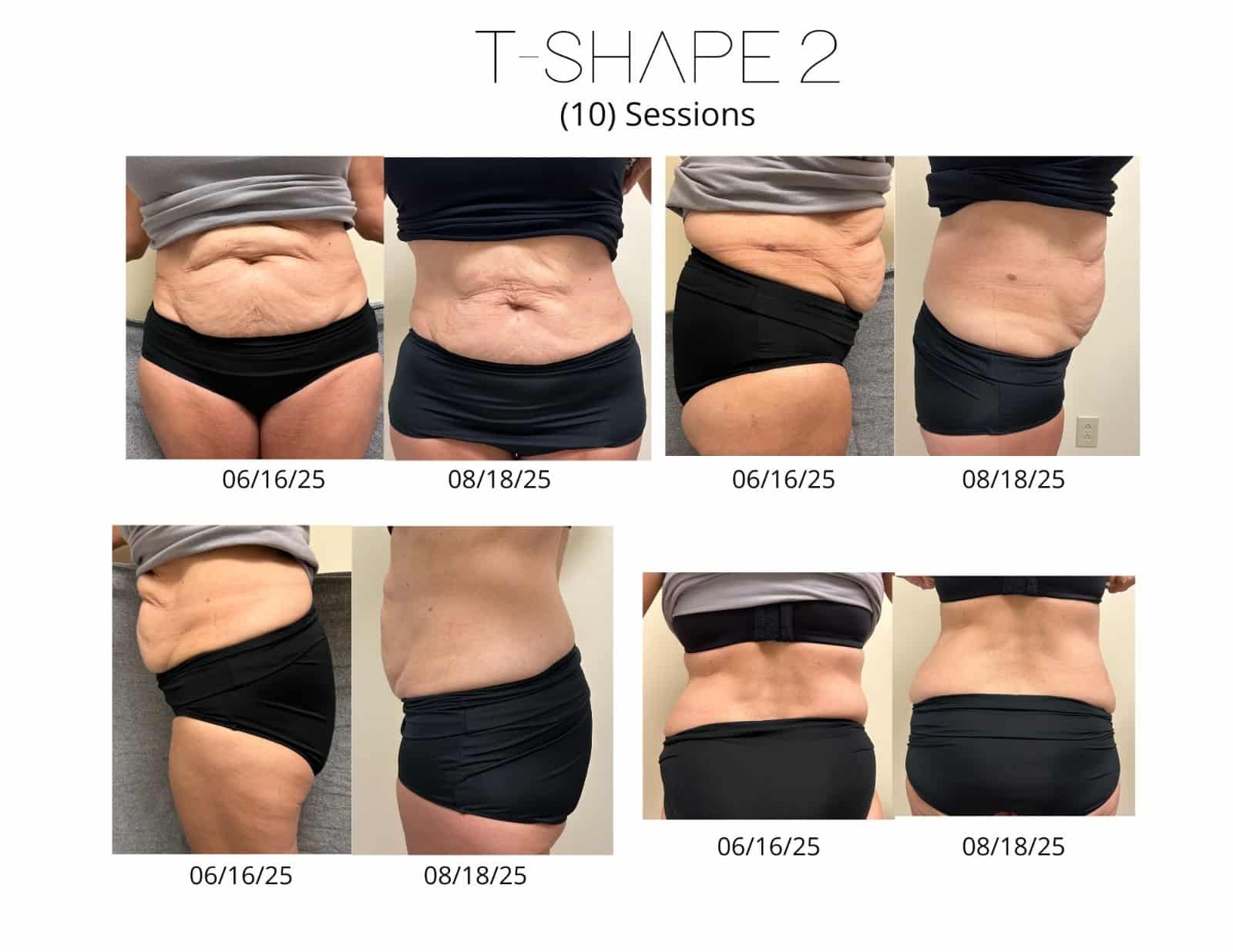 Before and After Image: T-Shape 2 - front